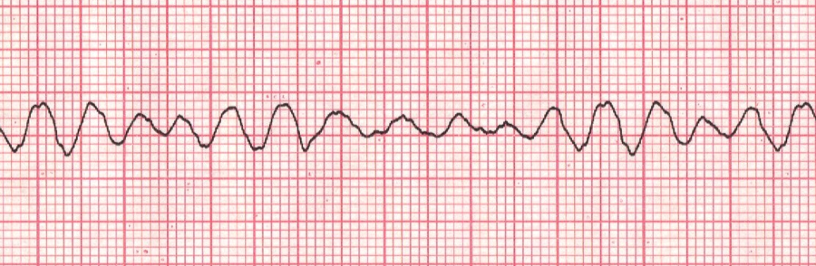 ventricular-fibrillation-medlibes-online-medical-library